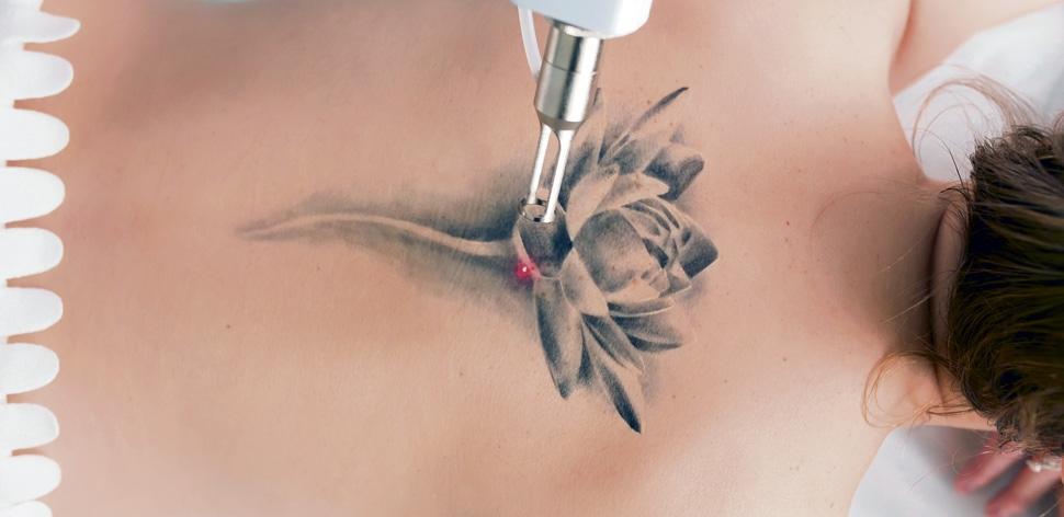 Modernste Tattoo-Entfernung im Zillertal